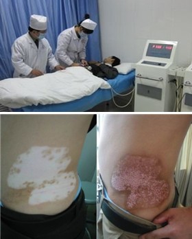 身上白癜风为何久治不愈