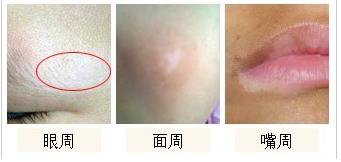 晕痣型白癜风和普通白癜风的区别