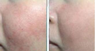 面部白癜风能够康复吗