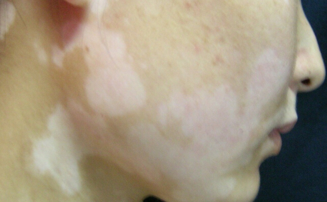 青少年脸部晕痣型白癜风应如何治疗