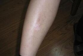 肢端型白癜风的具体症状表现