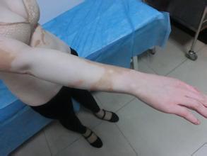 节段型白癜风疾病会发生遗传现象吗