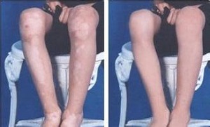 护理泛发型白癜风怎么做