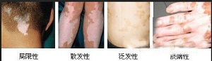 泛发型白癜风患者该注意什么