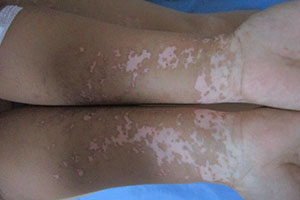 如何识别白癜风早期的症状